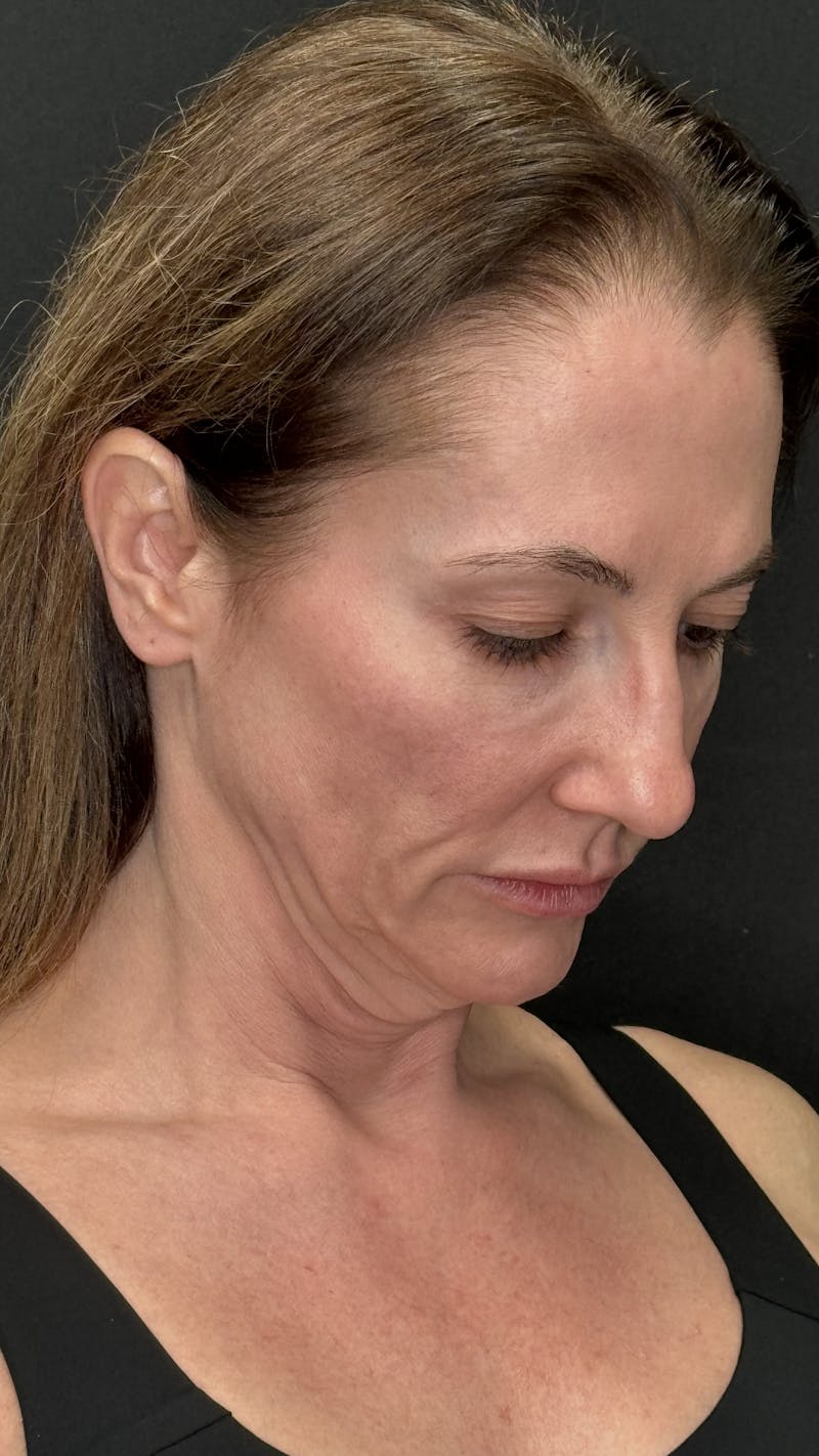 Deep Plane Facelift 40s Before & After Gallery - Patient 103560 - Image 5