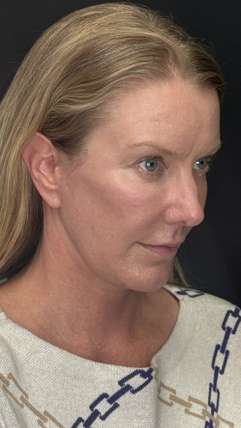Deep Plane Facelift 50s Before & After Gallery - Patient 333058 - Image 4