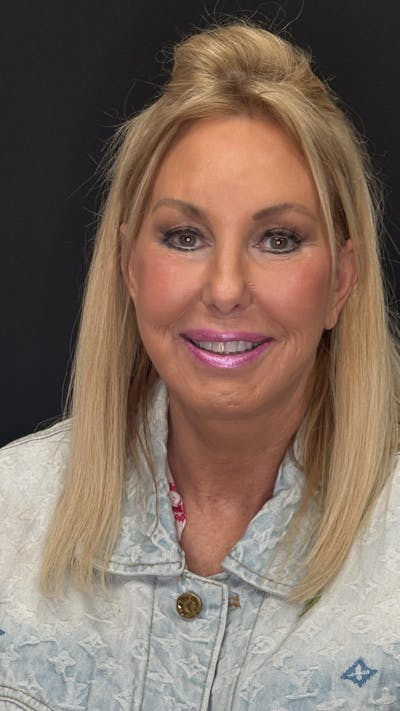 Deep Plane Facelift 60s Before & After Gallery - Patient 387554 - Image 2