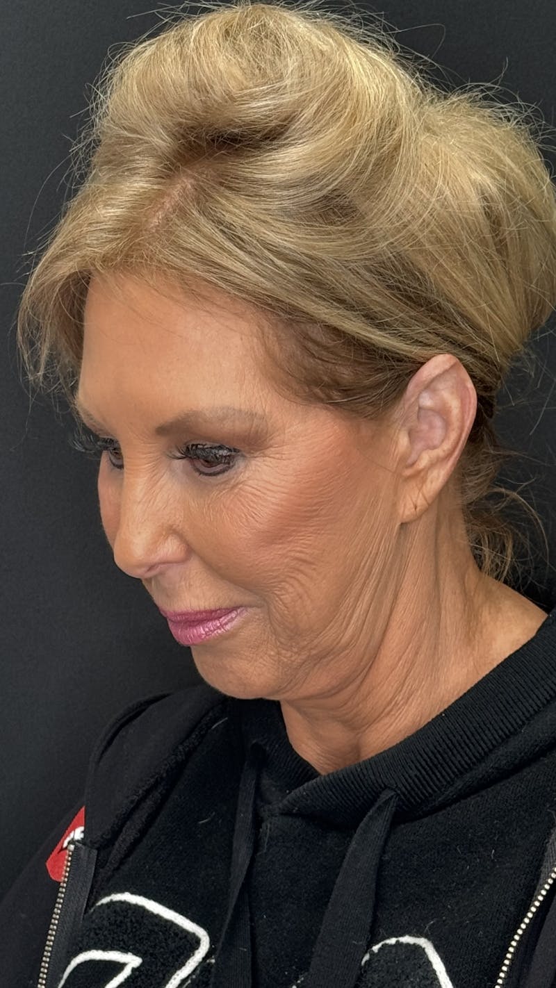 Deep Plane Facelift 60s Before & After Gallery - Patient 387554 - Image 7
