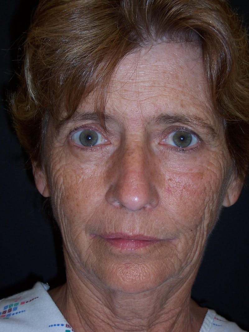 Laser Skin Resurfacing Before & After Gallery - Patient 283408 - Image 3