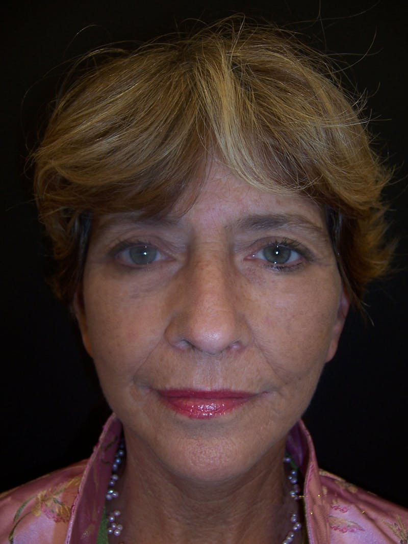 Laser Skin Resurfacing Before & After Gallery - Patient 283408 - Image 4