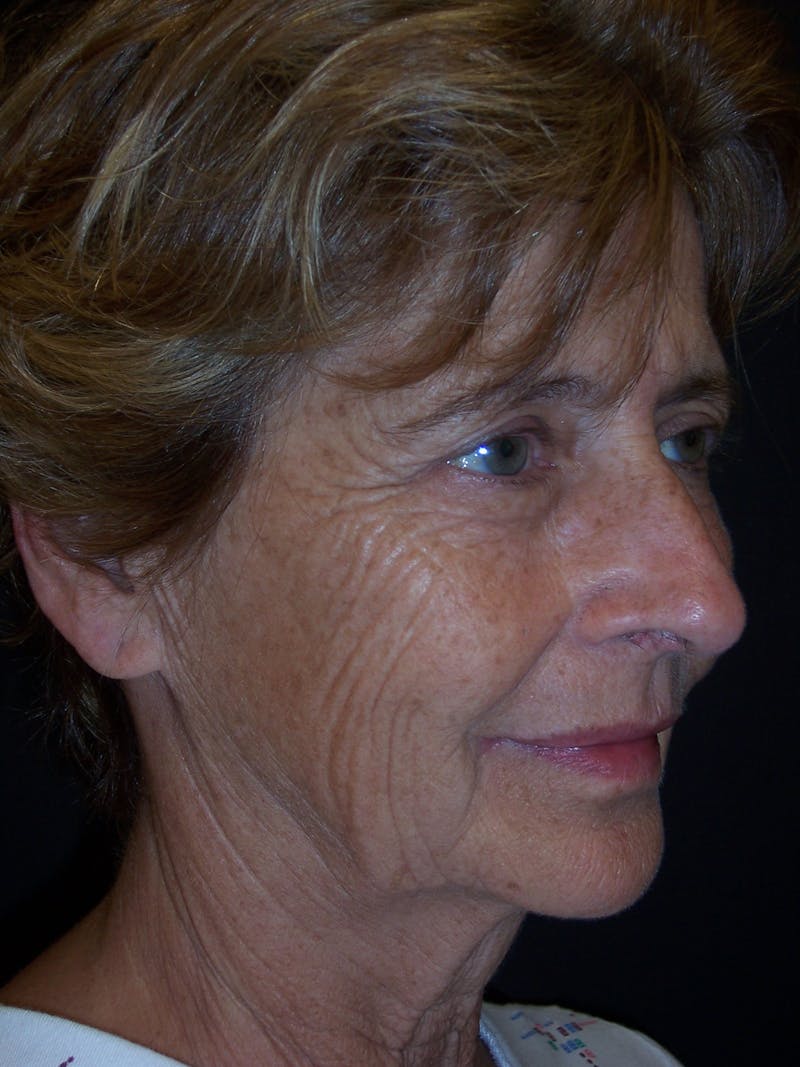 Laser Skin Resurfacing Before & After Gallery - Patient 283408 - Image 1
