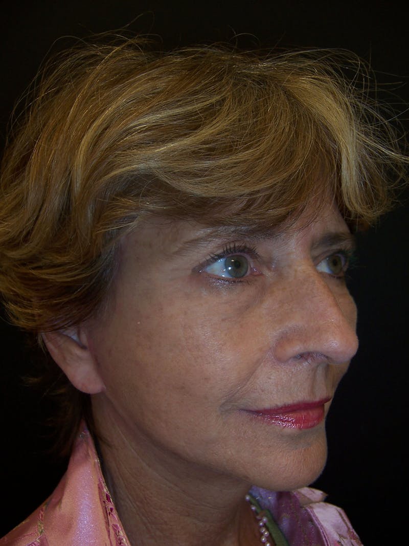 Laser Skin Resurfacing Before & After Gallery - Patient 283408 - Image 2