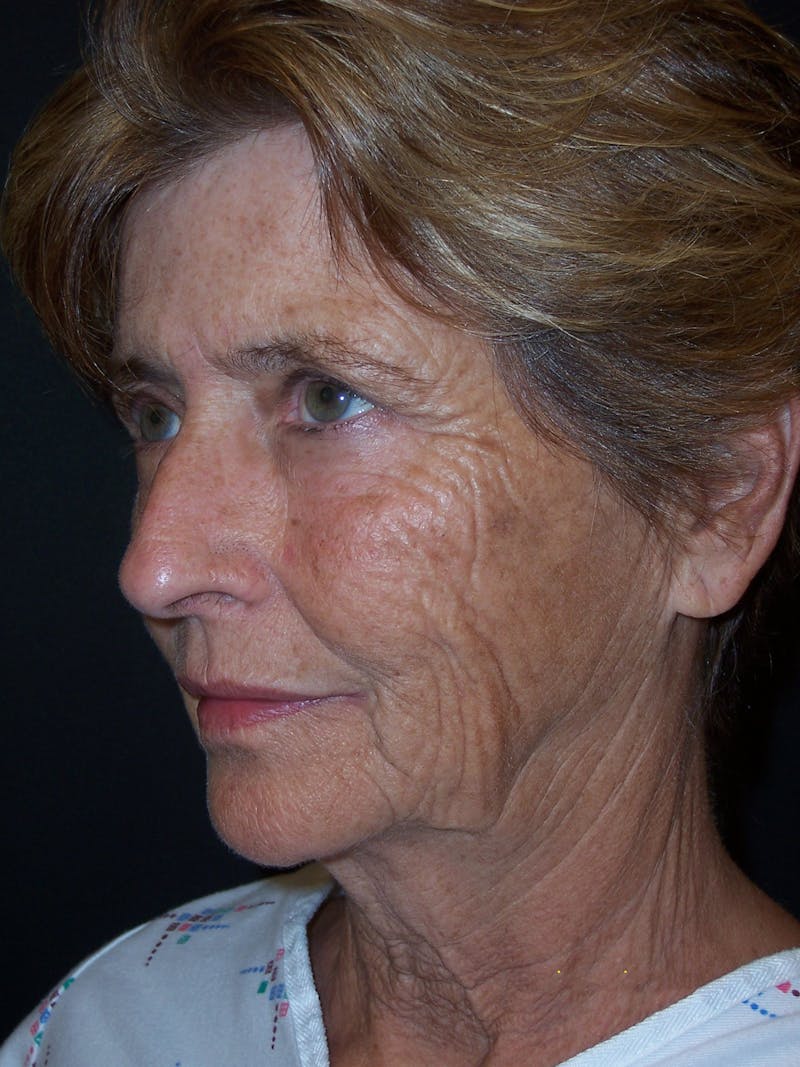 Laser Skin Resurfacing Before & After Gallery - Patient 283408 - Image 5
