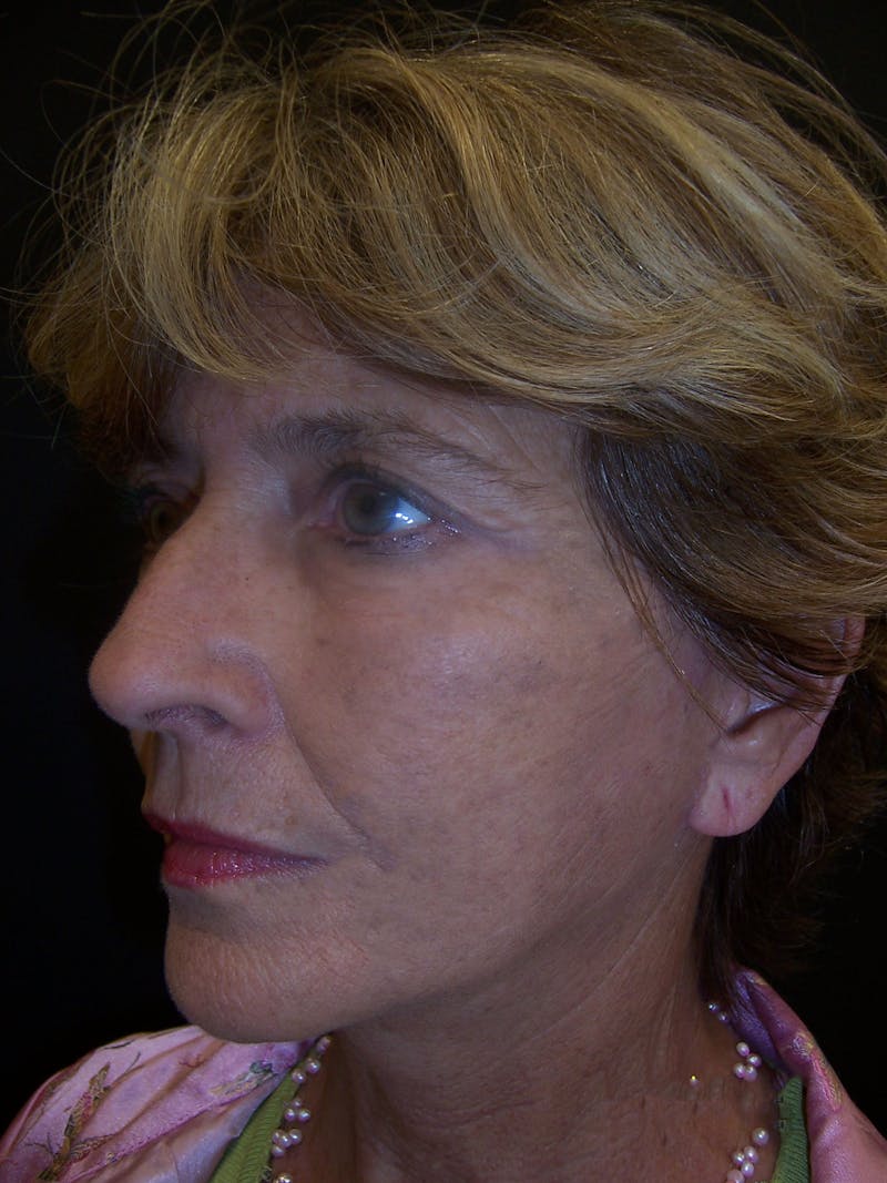 Laser Skin Resurfacing Before & After Gallery - Patient 283408 - Image 6