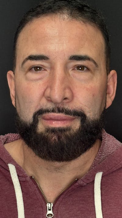 Lower Eye Rejuvenation Before & After Gallery - Patient 237385 - Image 1