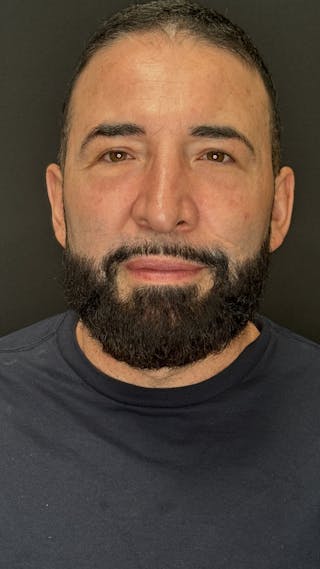 Lower Eye Rejuvenation Before & After Gallery - Patient 237385 - Image 2