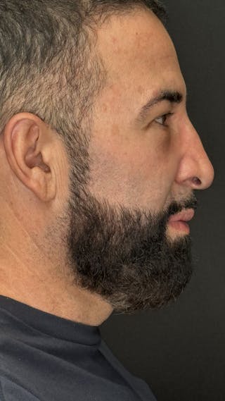 Lower Eye Rejuvenation Before & After Gallery - Patient 237385 - Image 4