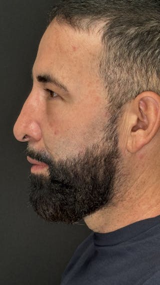 Lower Eye Rejuvenation Before & After Gallery - Patient 237385 - Image 6