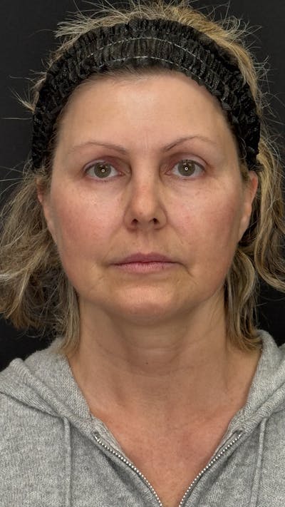 Mini Deep Plane Facelift Before & After Gallery - Patient 948584 - Image 1