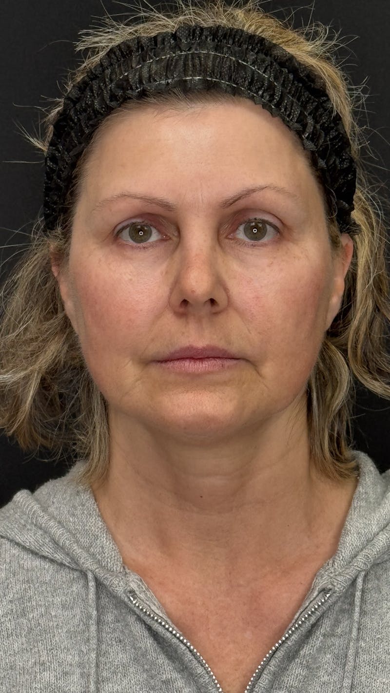 Mini Deep Plane Facelift Before & After Gallery - Patient 948584 - Image 1