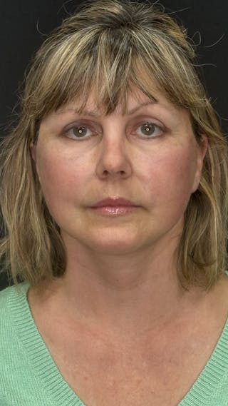 Mini Deep Plane Facelift Before & After Gallery - Patient 948584 - Image 2