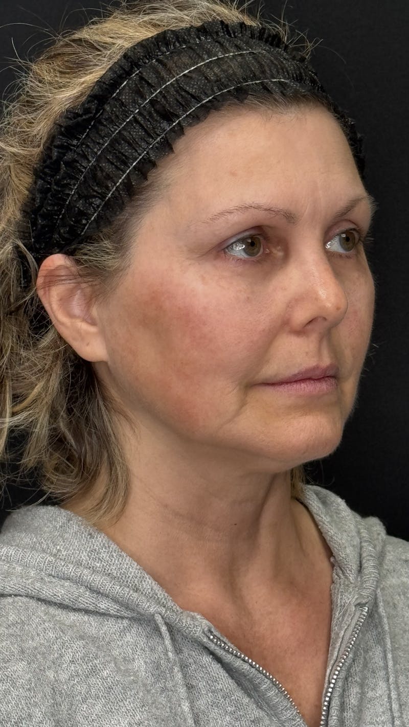 Mini Deep Plane Facelift Before & After Gallery - Patient 948584 - Image 3