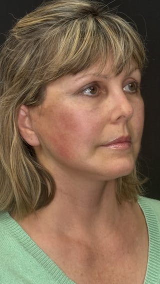 Mini Deep Plane Facelift Before & After Gallery - Patient 948584 - Image 4