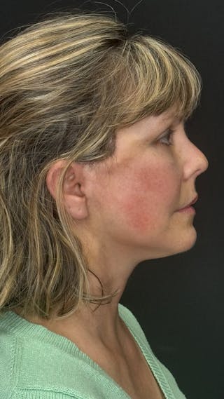 Mini Deep Plane Facelift Before & After Gallery - Patient 948584 - Image 6