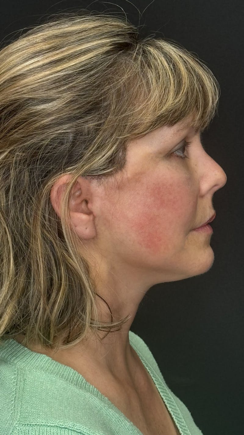 Mini Deep Plane Facelift Before & After Gallery - Patient 948584 - Image 6