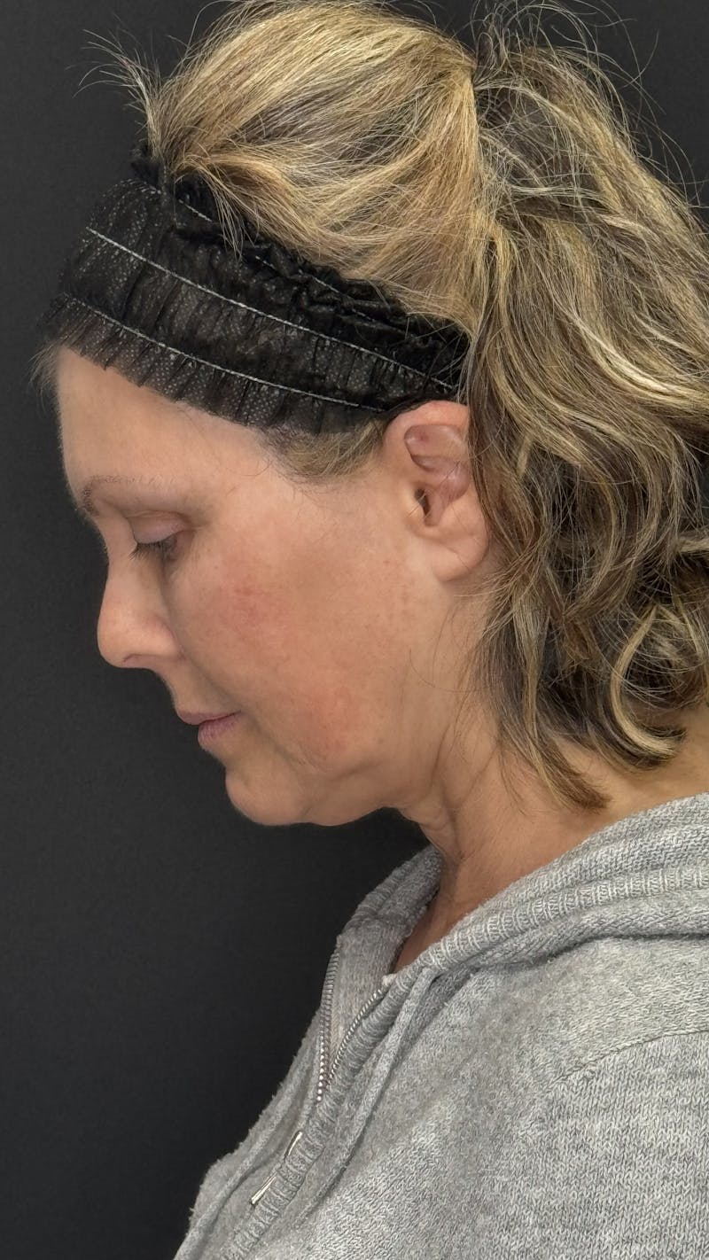 Mini Deep Plane Facelift Before & After Gallery - Patient 948584 - Image 7