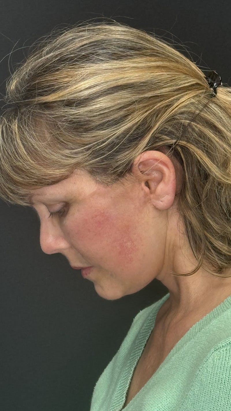 Mini Deep Plane Facelift Before & After Gallery - Patient 948584 - Image 8