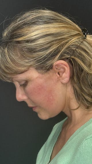 Mini Deep Plane Facelift Before & After Gallery - Patient 948584 - Image 8