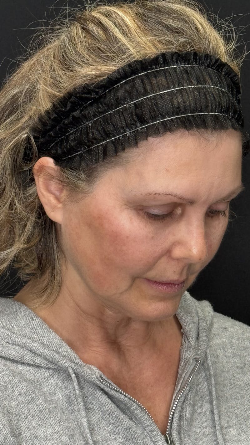 Mini Deep Plane Facelift Before & After Gallery - Patient 948584 - Image 9