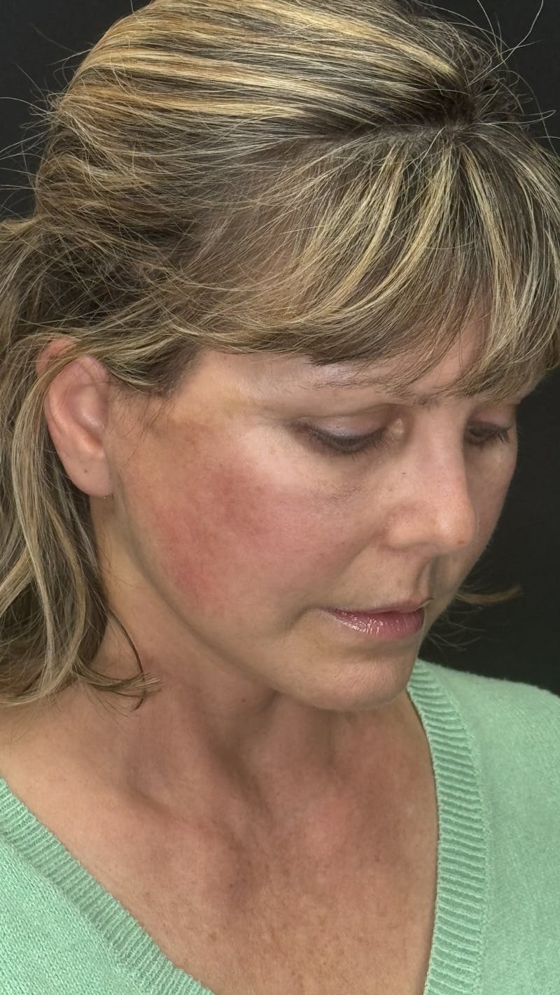 Mini Deep Plane Facelift Before & After Gallery - Patient 948584 - Image 10