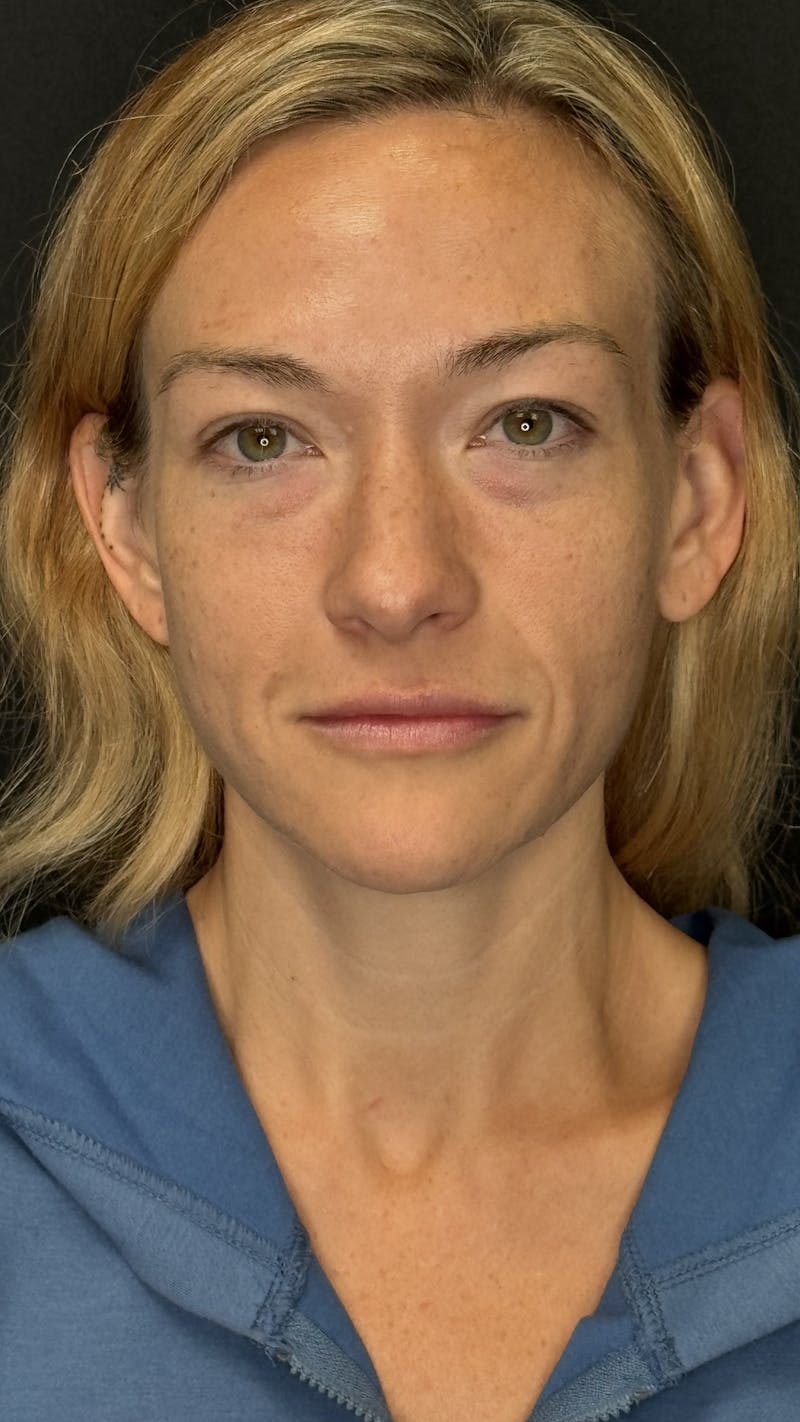 Mini Deep Plane Facelift Before & After Gallery - Patient 458420 - Image 1