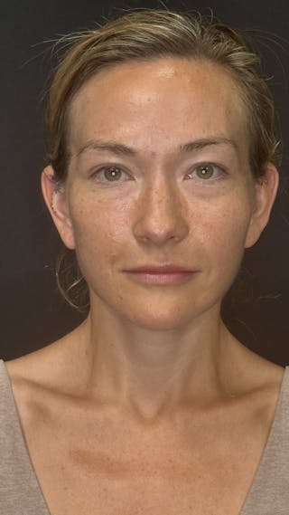 Deep Plane Facelift 40s Before & After Gallery - Patient 289160 - Image 2