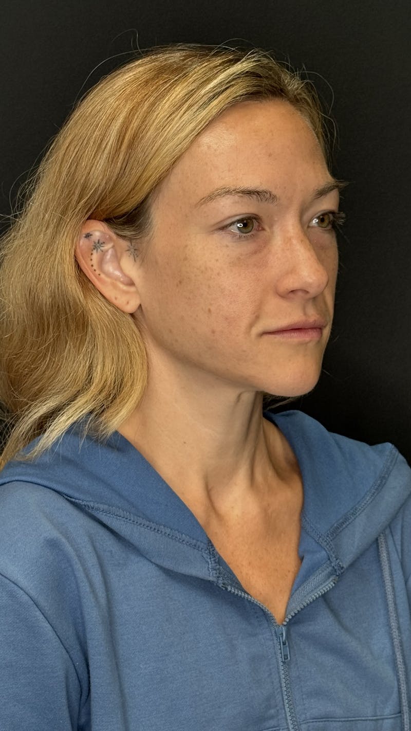 Mini Deep Plane Facelift Before & After Gallery - Patient 458420 - Image 3