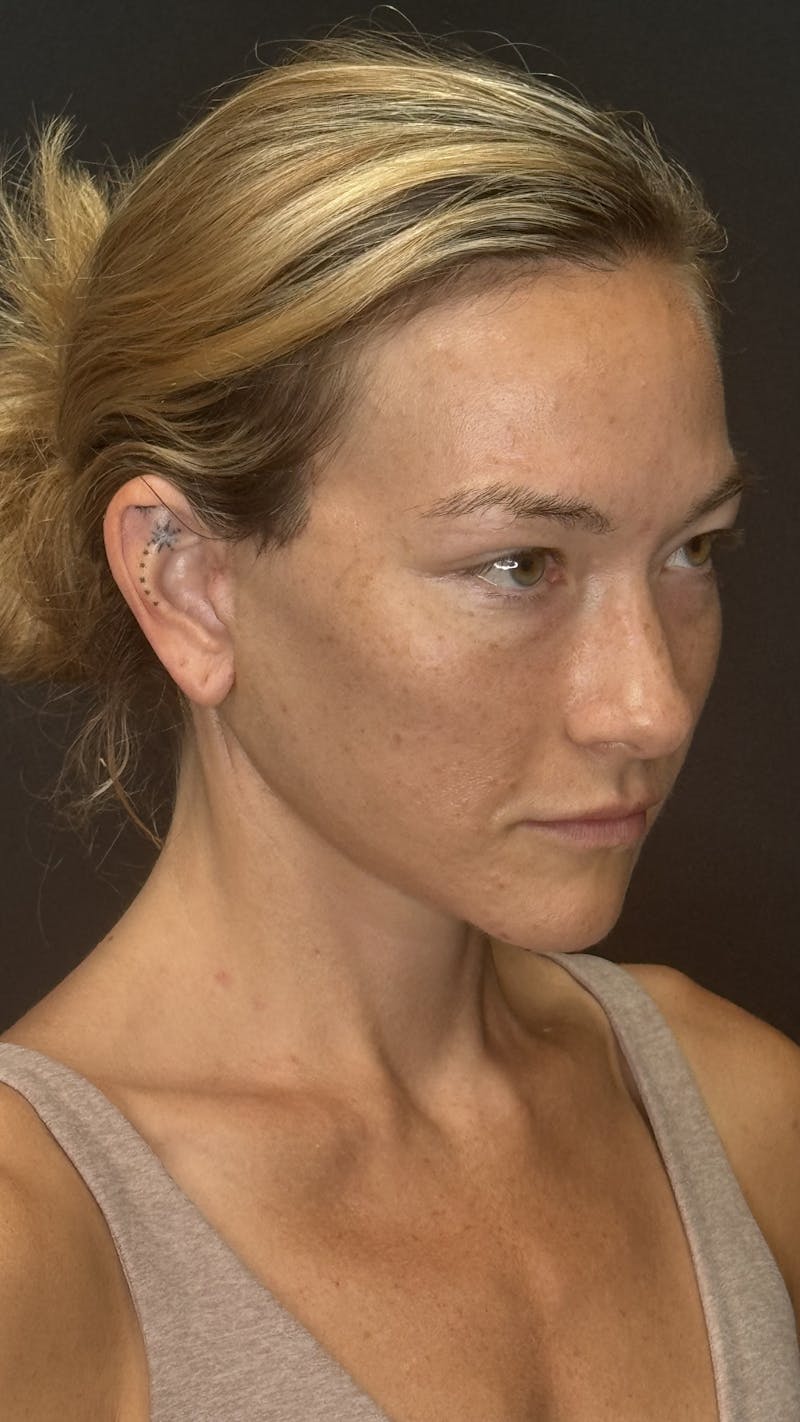 Mini Deep Plane Facelift Before & After Gallery - Patient 458420 - Image 6