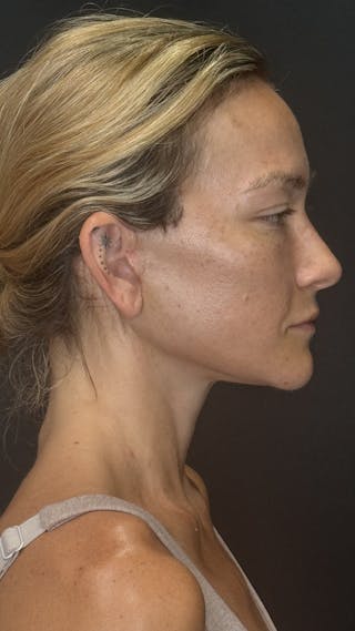 Deep Plane Facelift 40s Before & After Gallery - Patient 289160 - Image 10