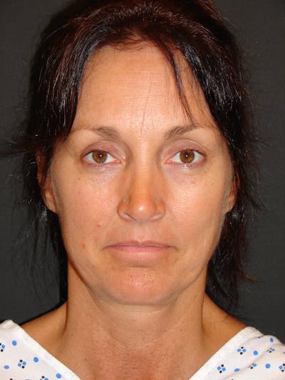 Mini Deep Plane Facelift Before & After Gallery - Patient 397057 - Image 1