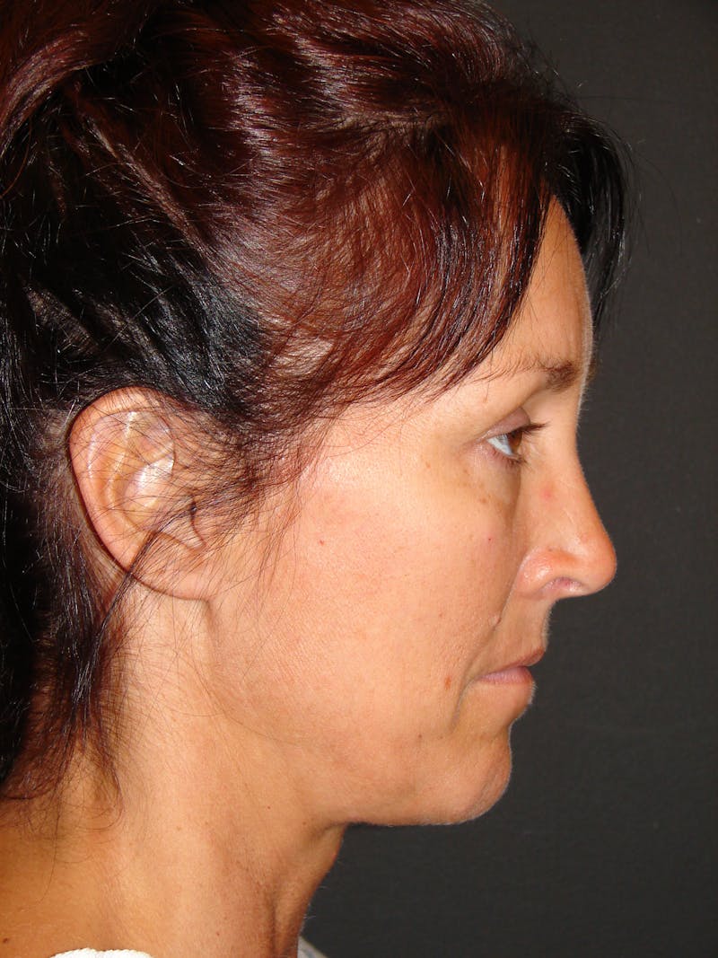 Mini Deep Plane Facelift Before & After Gallery - Patient 397057 - Image 5