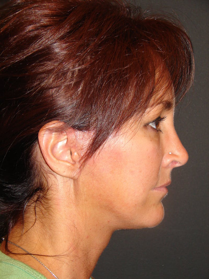 Mini Deep Plane Facelift Before & After Gallery - Patient 397057 - Image 6