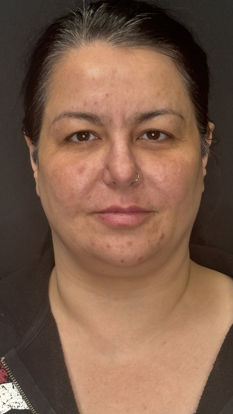 Upper Eye Rejuvenation Before & After Gallery - Patient 133928 - Image 3