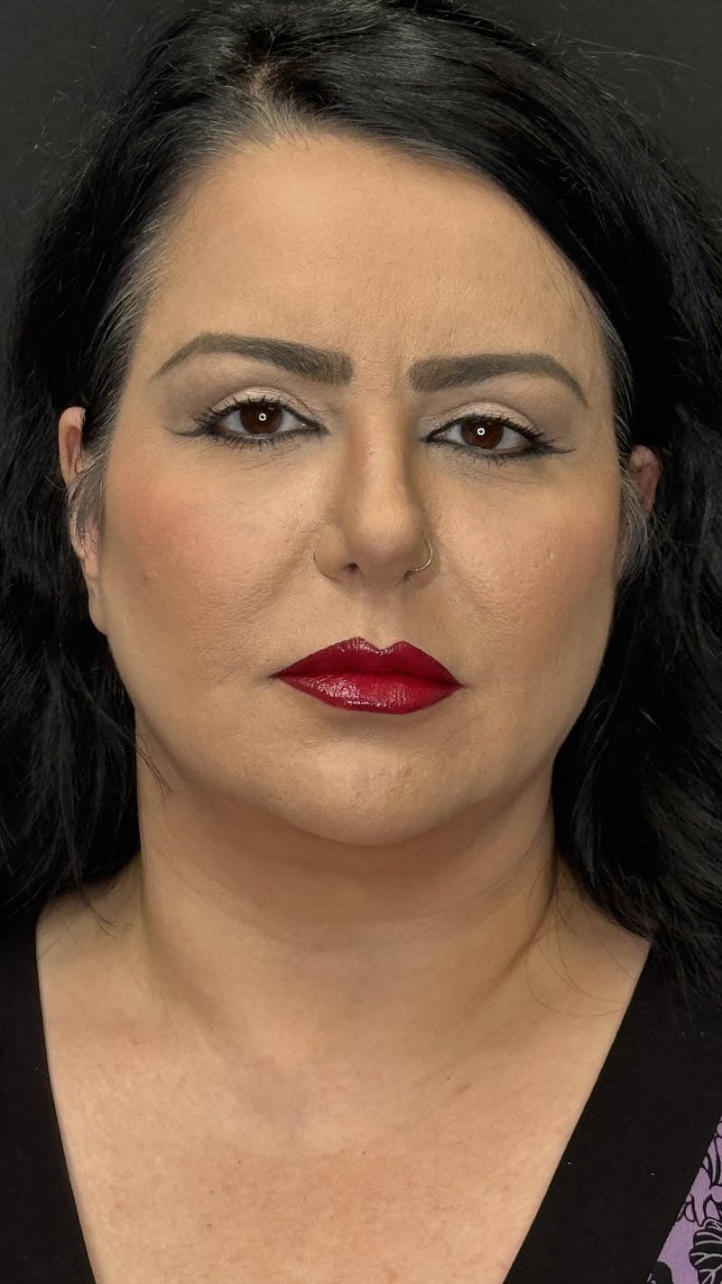 Upper Eye Rejuvenation Before & After Gallery - Patient 133928 - Image 4