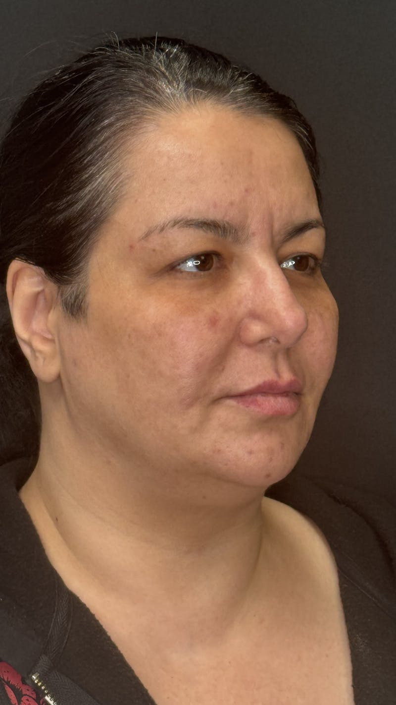Upper Eye Rejuvenation Before & After Gallery - Patient 133928 - Image 1