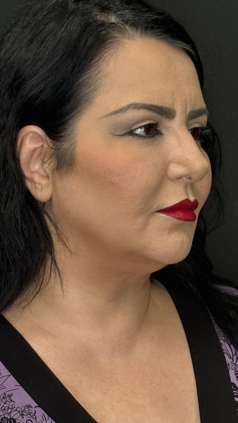 Upper Eye Rejuvenation Before & After Gallery - Patient 133928 - Image 2