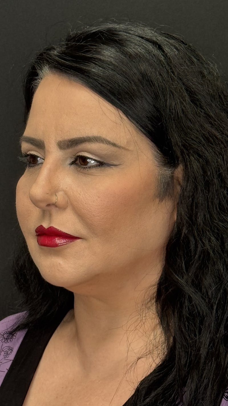 Upper Eye Rejuvenation Before & After Gallery - Patient 133928 - Image 6