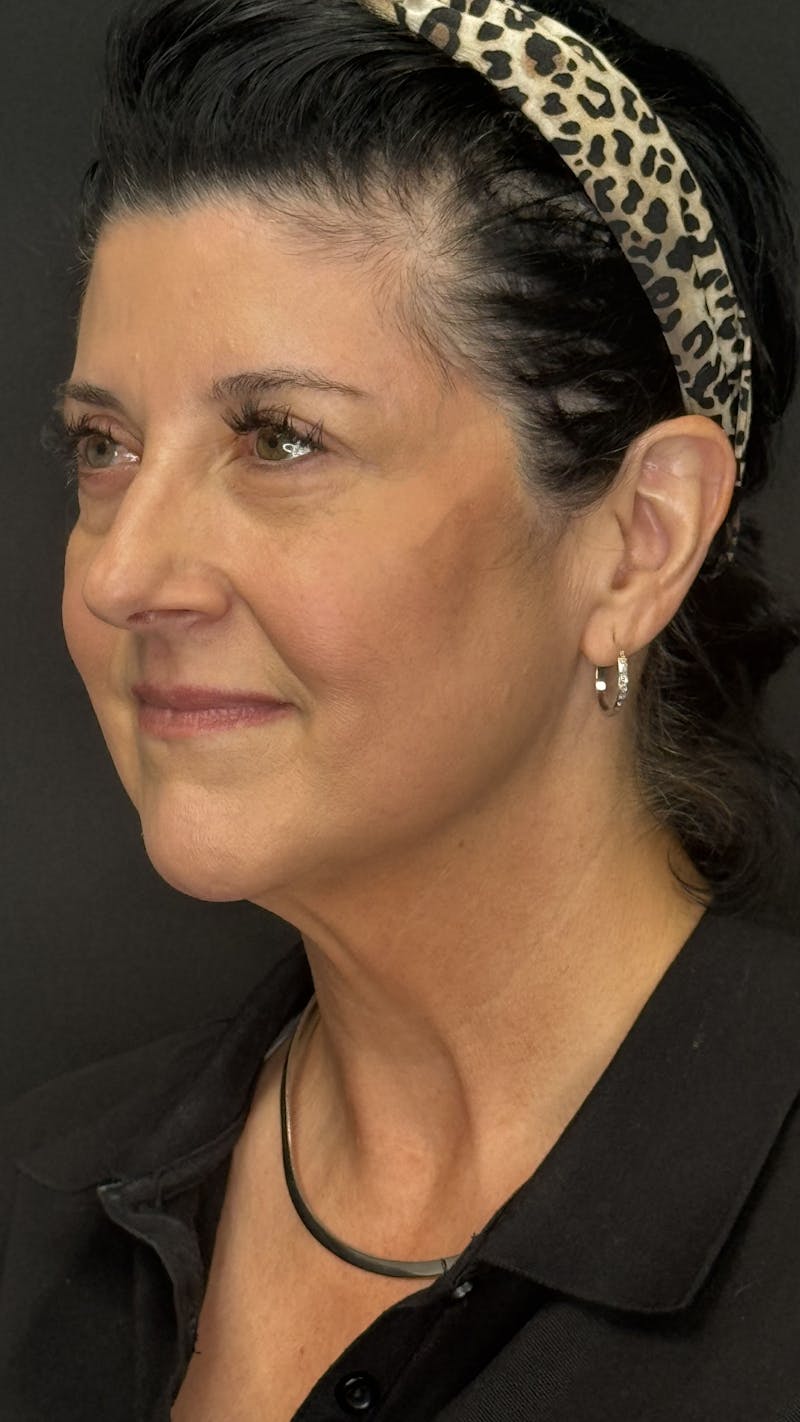 Upper Eye Rejuvenation Before & After Gallery - Patient 208855 - Image 4