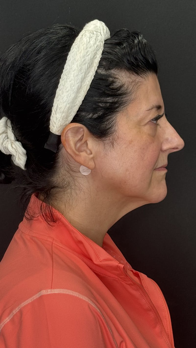 Upper Eye Rejuvenation Before & After Gallery - Patient 208855 - Image 1