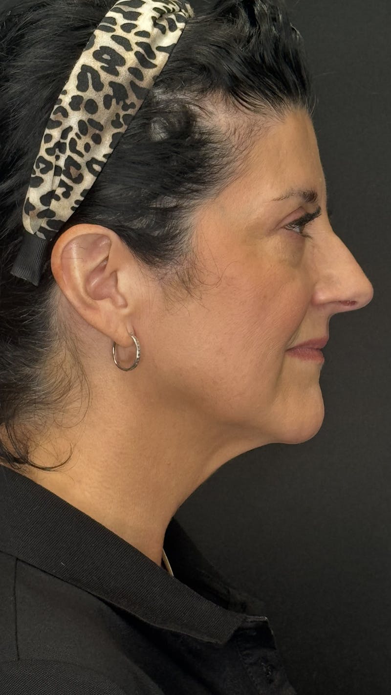 Upper Eye Rejuvenation Before & After Gallery - Patient 208855 - Image 2