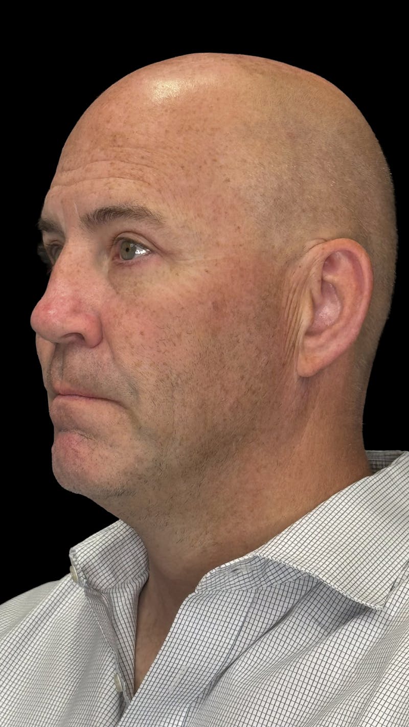Upper Eye Rejuvenation Before & After Gallery - Patient 634069 - Image 4