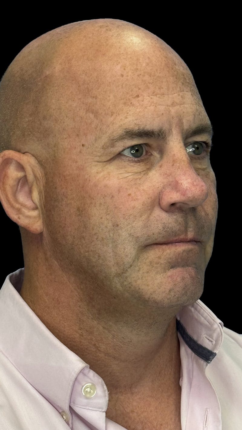 Upper Eye Rejuvenation Before & After Gallery - Patient 634069 - Image 1
