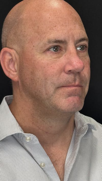 Upper Eye Rejuvenation Before & After Gallery - Patient 634069 - Image 2