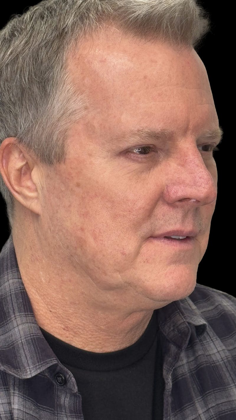Upper Eye Rejuvenation Before & After Gallery - Patient 168724 - Image 2