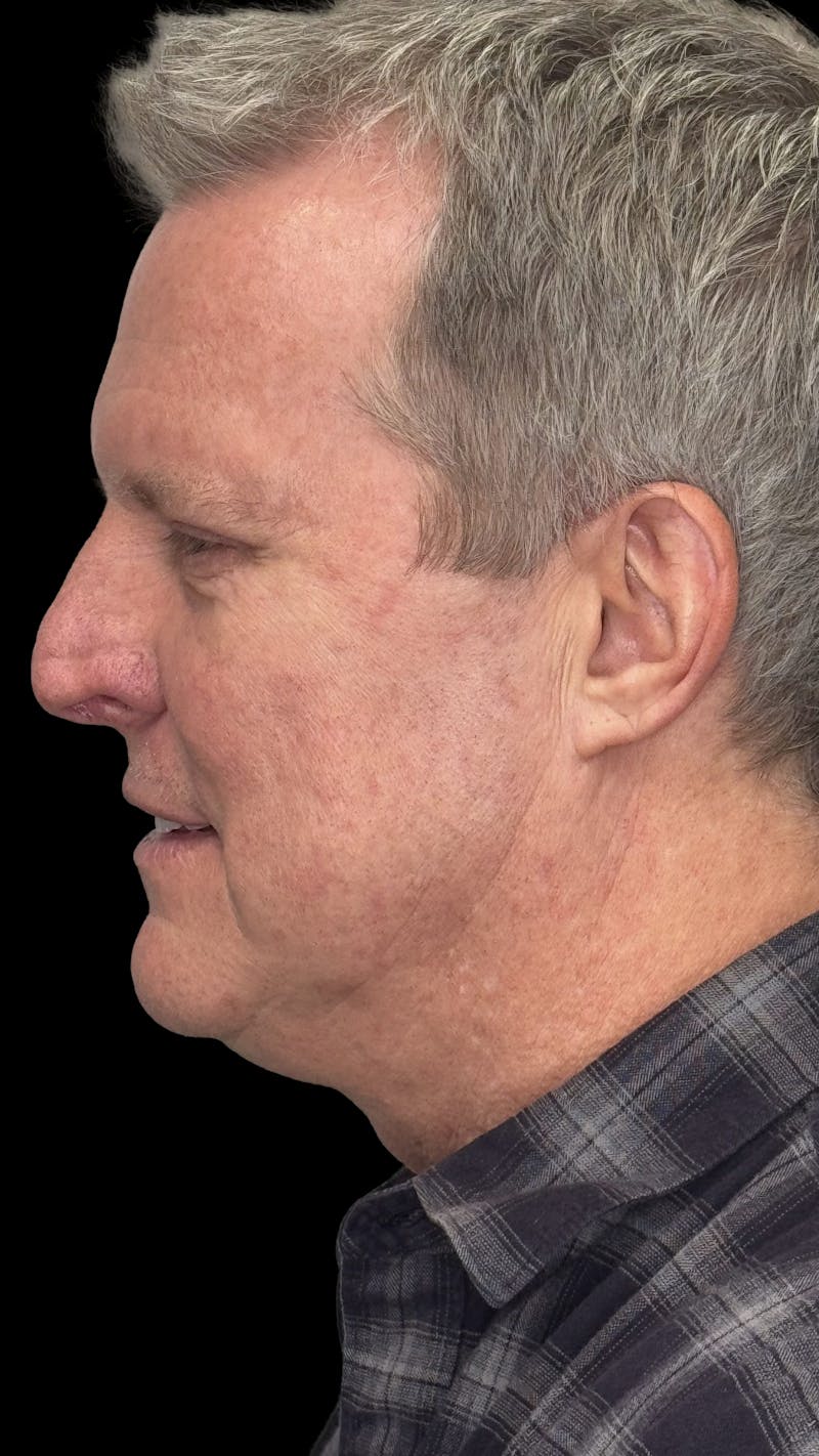 Upper Eye Rejuvenation Before & After Gallery - Patient 168724 - Image 4