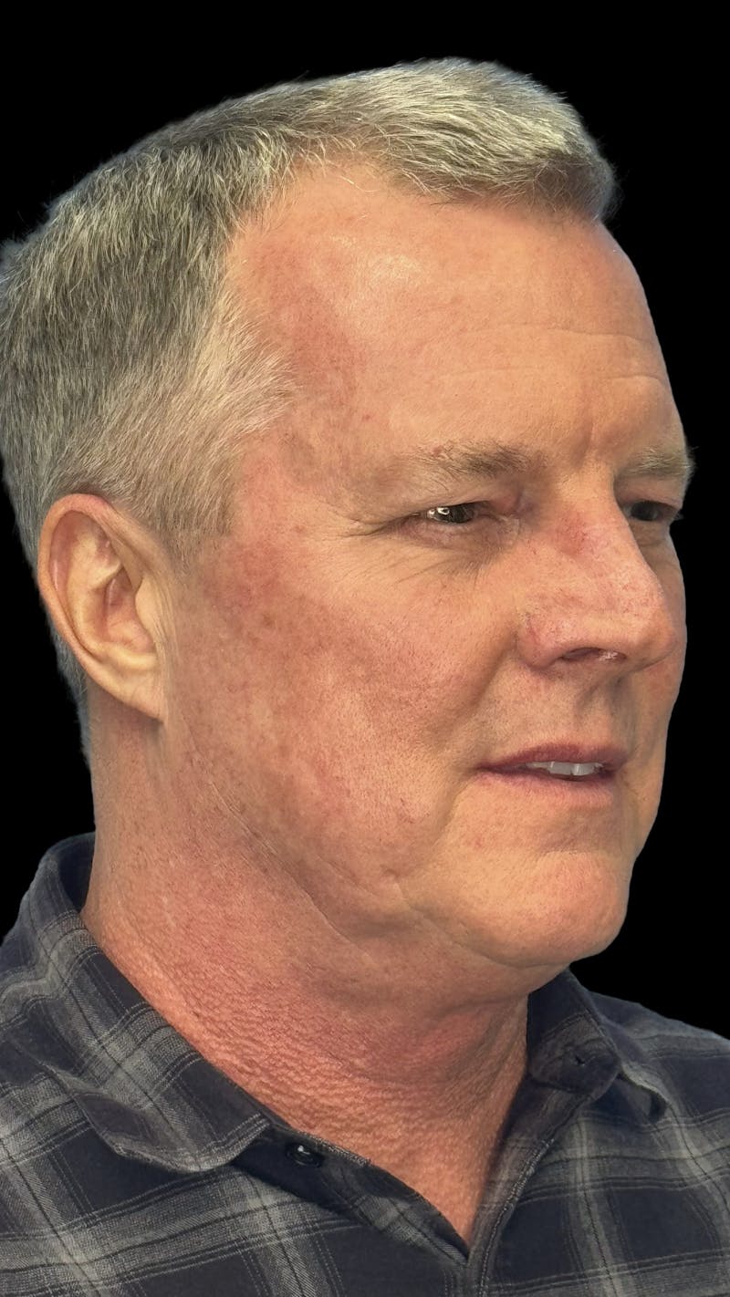 Upper Eye Rejuvenation Before & After Gallery - Patient 168724 - Image 1
