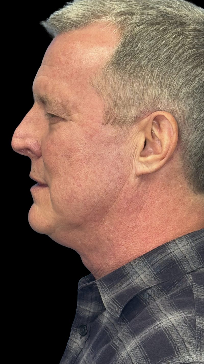 Upper Eye Rejuvenation Before & After Gallery - Patient 168724 - Image 3