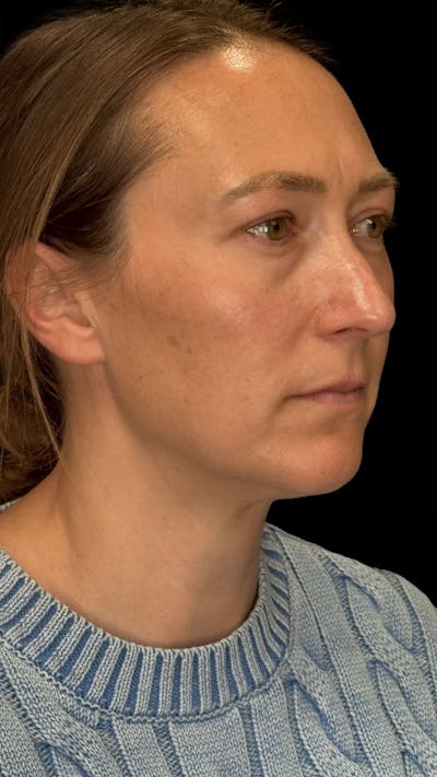 Upper Eye Rejuvenation Before & After Gallery - Patient 267655 - Image 2